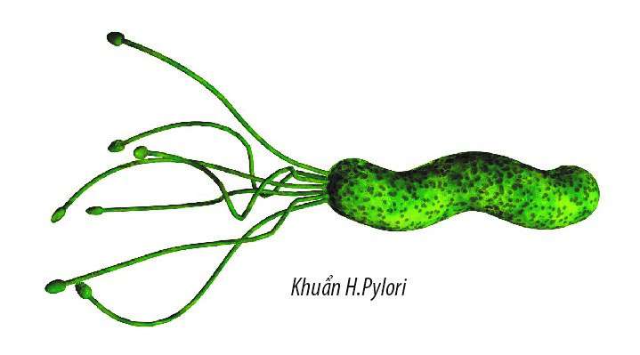 Nhiễm vi khuẩn H.Pylori – Khi nào cần điều trị?