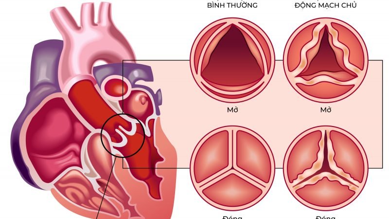 BỆNH VIỆN FV TIÊN PHONG ỨNG DỤNG CÔNG NGHỆ THAY VAN ĐỘNG MẠCH CHỦ THẾ HỆ MỚI NHẤT